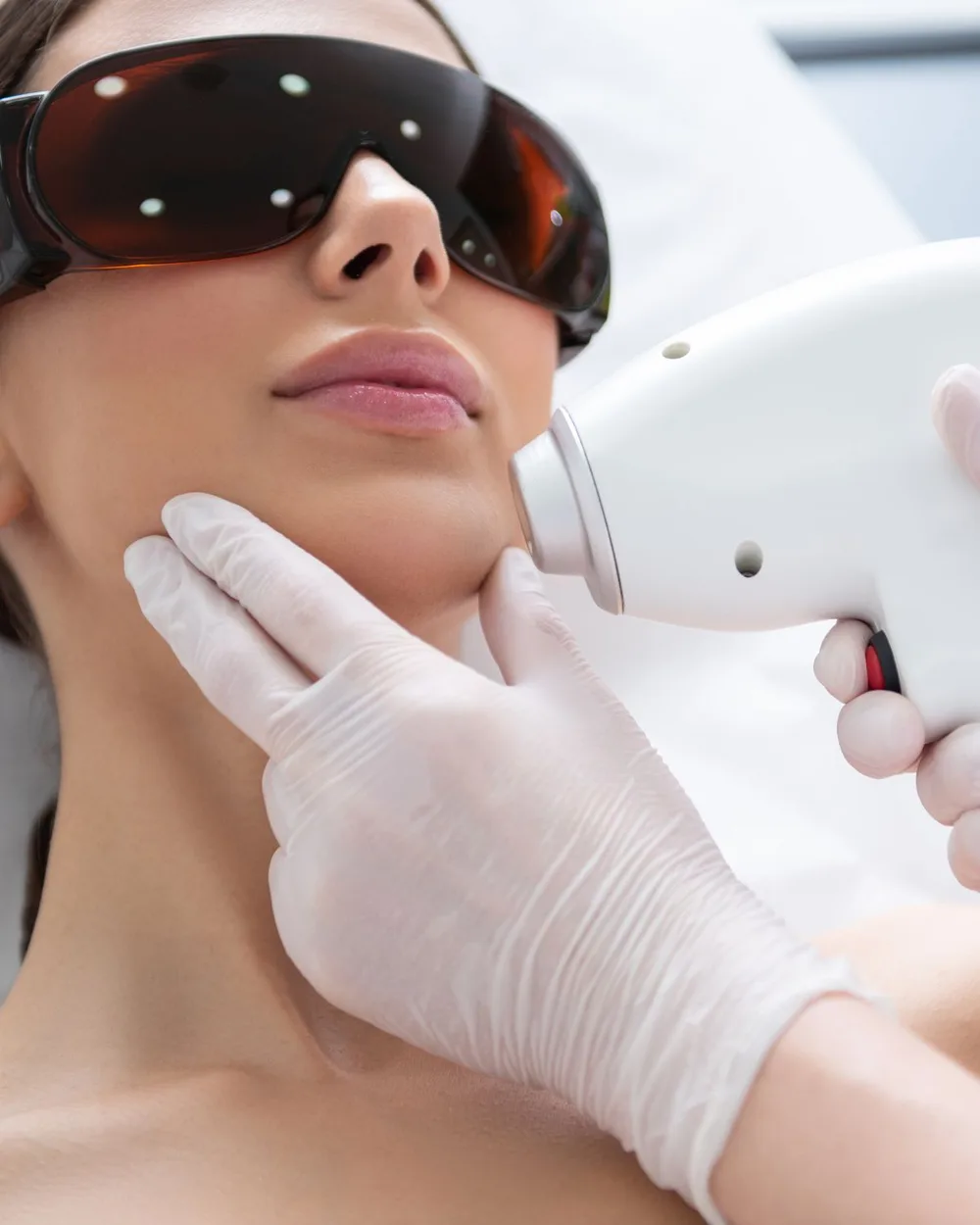 Laser-Haarentfernung im Gesicht mit Schutzbrille bei Seve Aesthetics