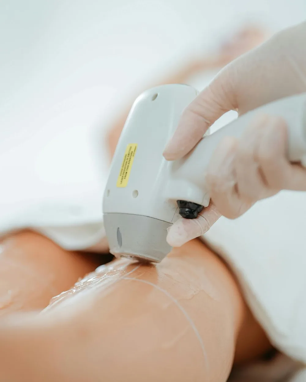 Laser-Haarentfernung am Bein während der Behandlung bei Seve Aesthetics